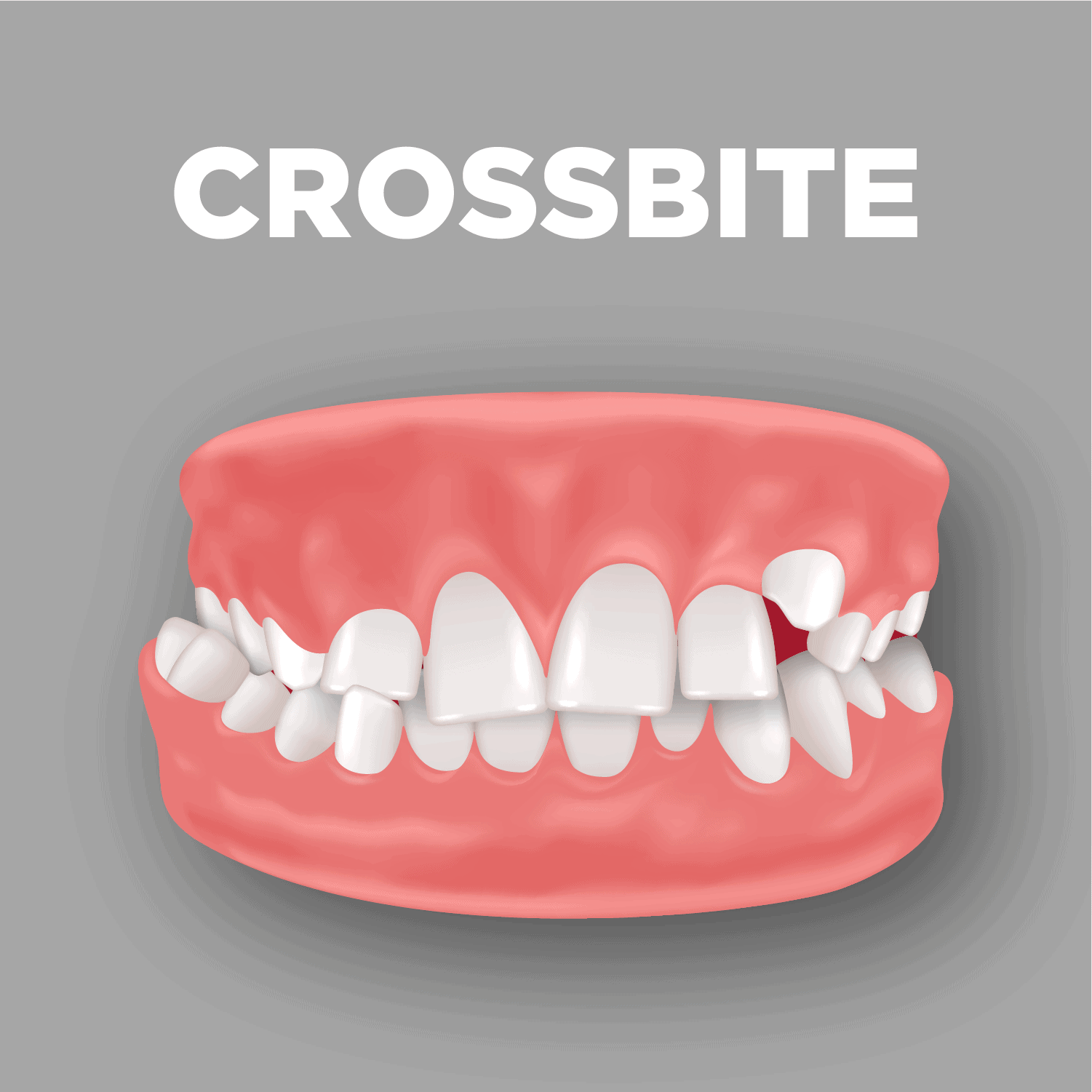 Crossbite