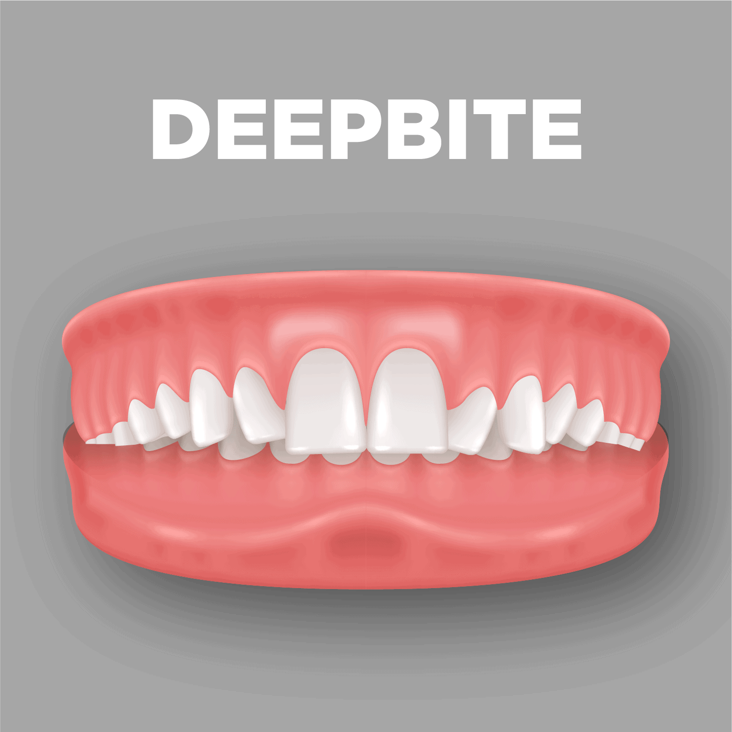 Deepbite