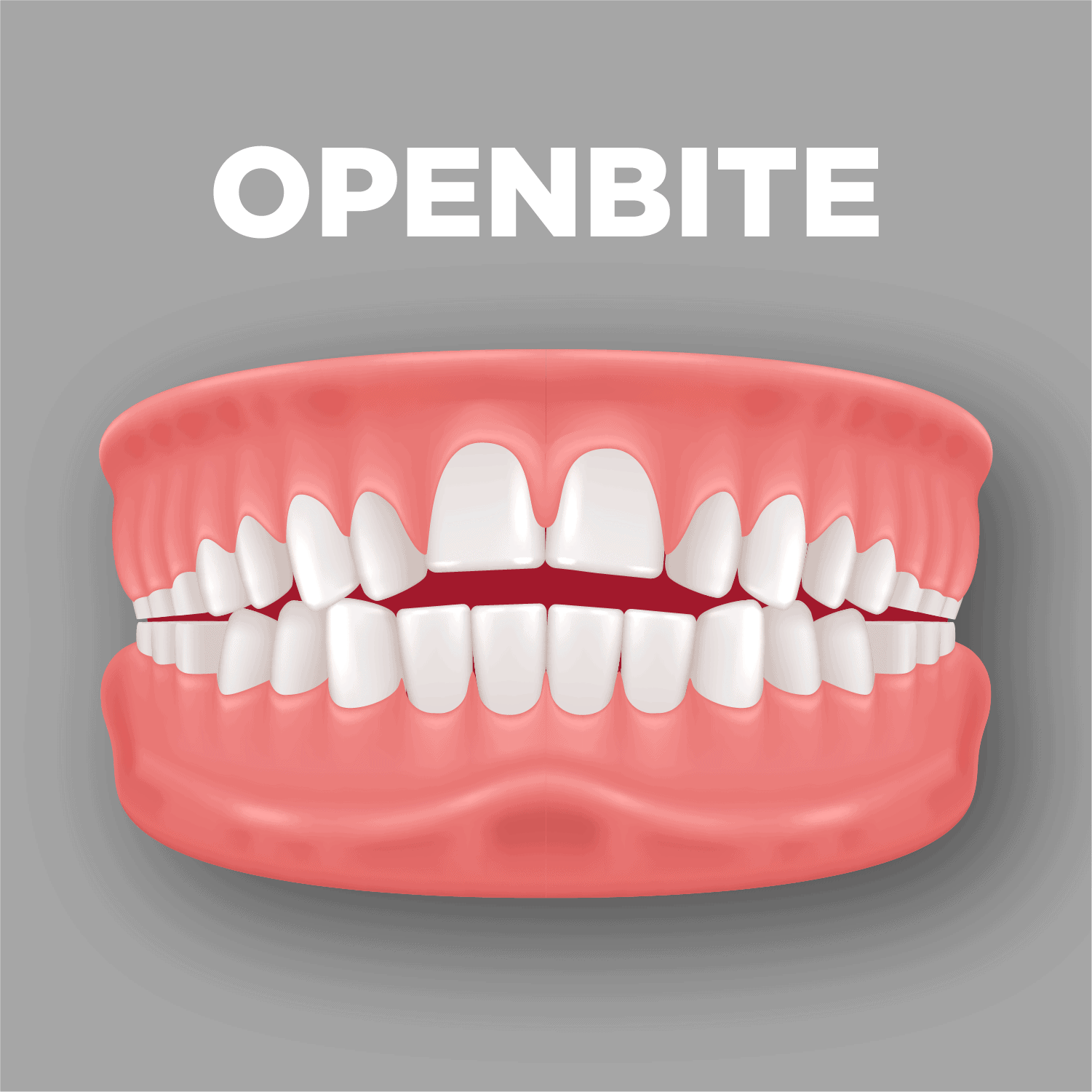 Openbite
